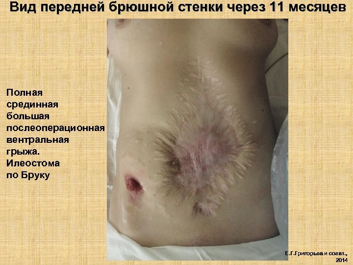 Вид передней брюшной стенки через 11 месяцев Полная срединная большая послеоперационная вентральная грыжа. Илеостома