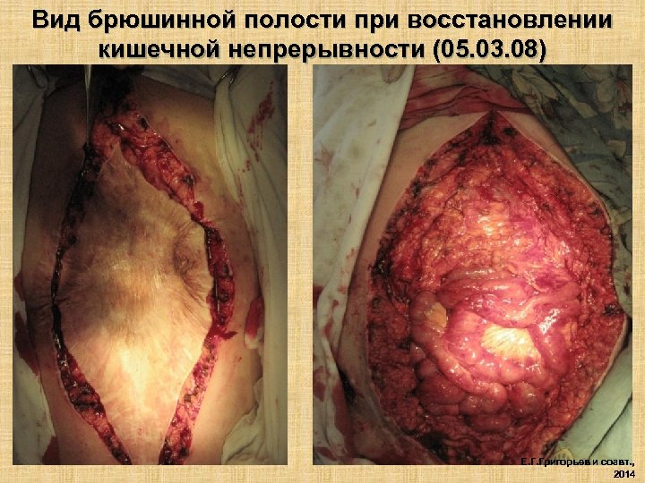 Вид брюшинной полости при восстановлении кишечной непрерывности (05. 03. 08) Е. Г. Григорьев и