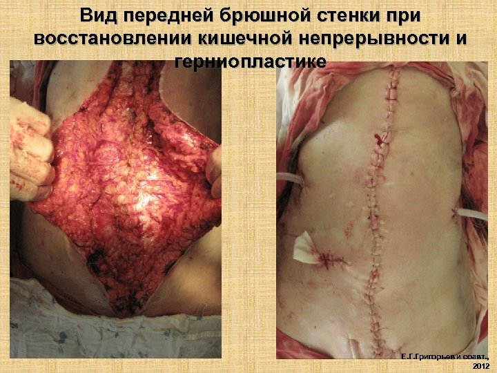 Вид передней брюшной стенки при восстановлении кишечной непрерывности и герниопластике Е. Г. Григорьев и
