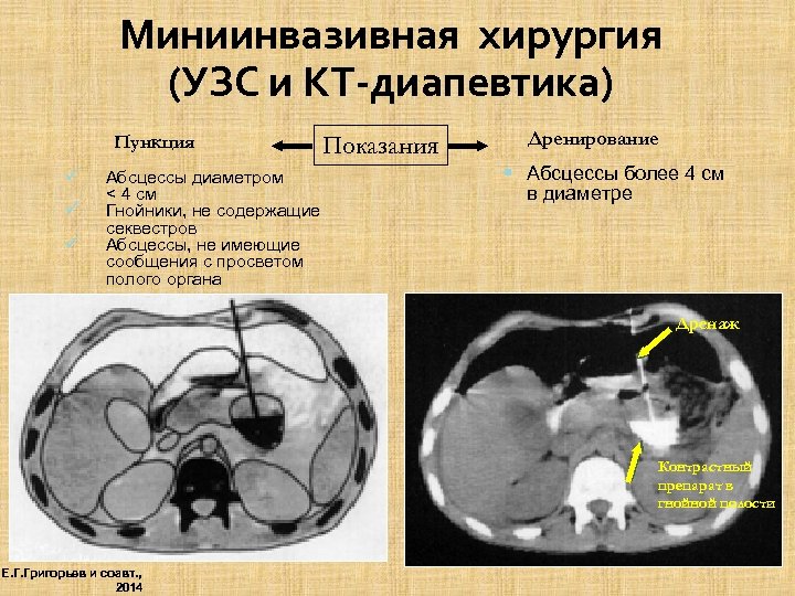 Миниинвазивная хирургия (УЗС и КТ-диапевтика) Пункция ü ü ü Абсцессы диаметром < 4 см