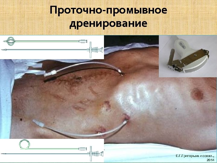 Проточно-промывное дренирование Е. Г. Григорьев и соавт. , 2014 