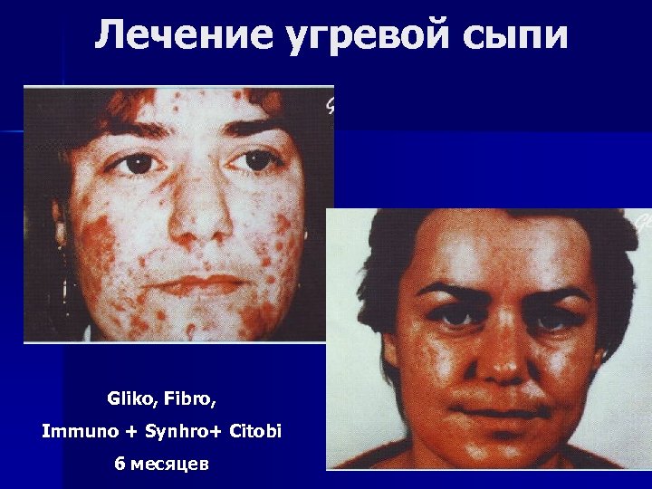 Лечение угревой сыпи Gliko, Fibro, Immuno + Synhro+ Citobi 6 месяцев 