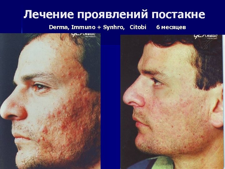 Лечение проявлений постакне Derma, Immuno + Synhro, Citobi 6 месяцев 