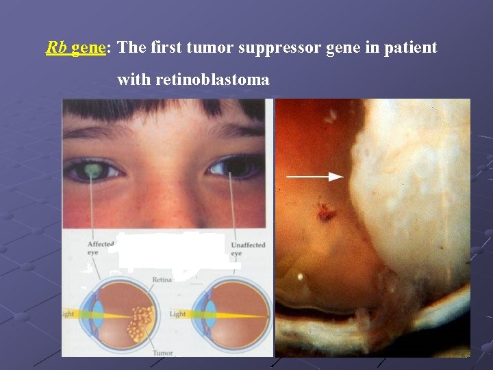 Rb gene: The first tumor suppressor gene in patient with retinoblastoma 