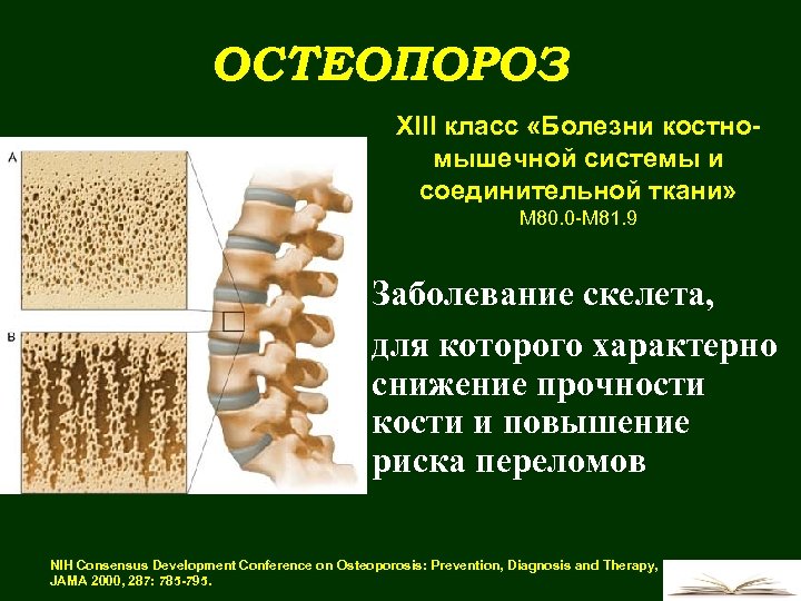 ОСТЕОПОРОЗ XIII класс «Болезни костномышечной системы и соединительной ткани» М 80. 0 -М 81.
