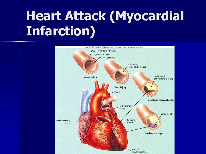 Heart Attack (Myocardial Infarction) 