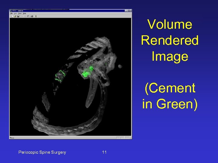 Volume Rendered Image (Cement in Green) Periscopic Spine Surgery 11 