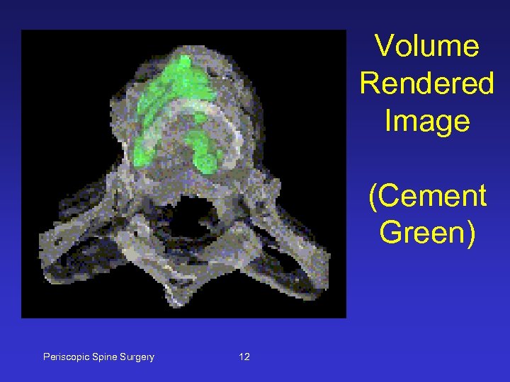 Volume Rendered Image (Cement Green) Periscopic Spine Surgery 12 