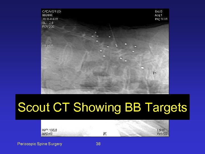 Scout CT Showing BB Targets Periscopic Spine Surgery 38 
