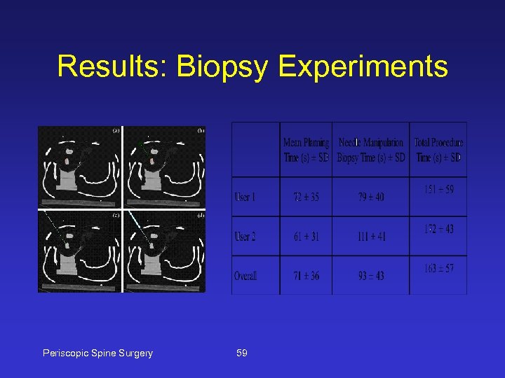 Results: Biopsy Experiments Periscopic Spine Surgery 59 