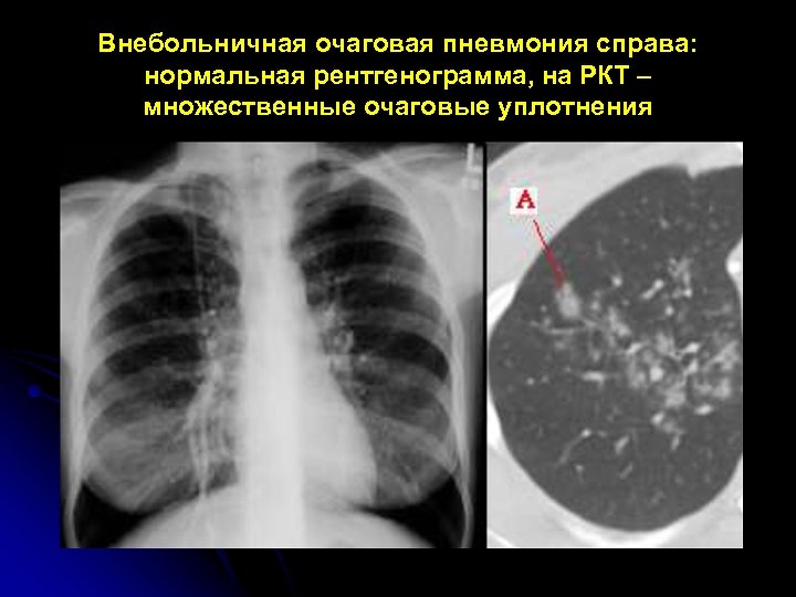 Внебольничная очаговая пневмония справа: нормальная рентгенограмма, на РКТ – множественные очаговые уплотнения 