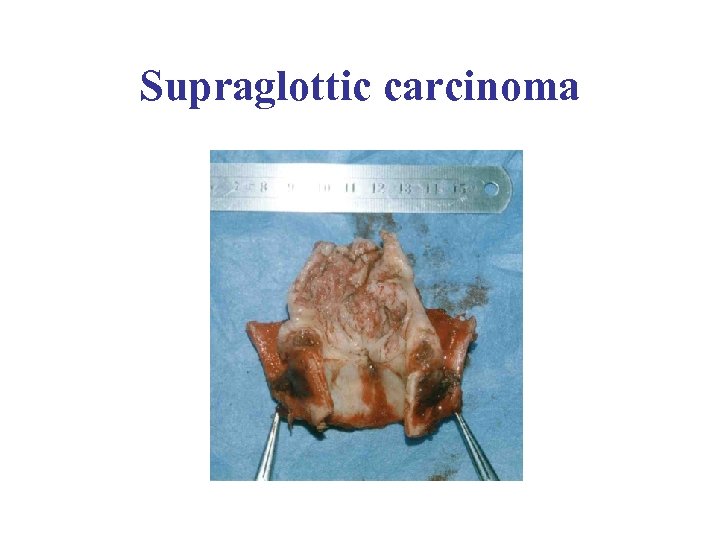 Supraglottic carcinoma 