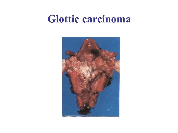 Glottic carcinoma 