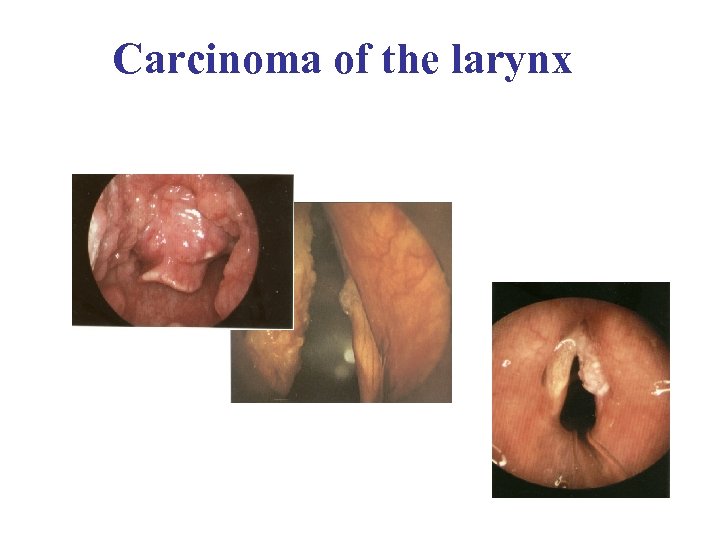 Carcinoma of the larynx 