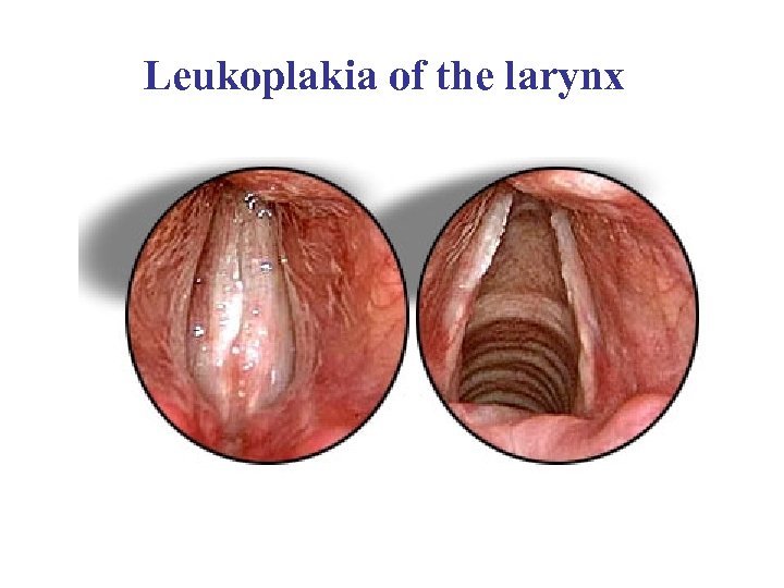 Leukoplakia of the larynx 