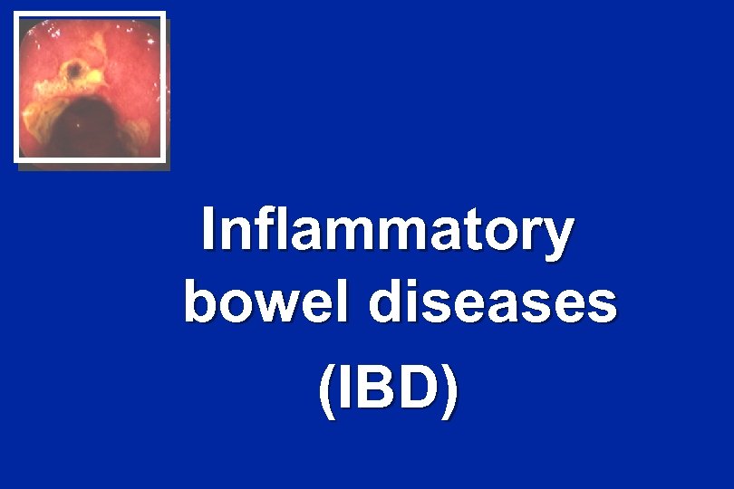 Inflammatory bowel diseases (IBD) 