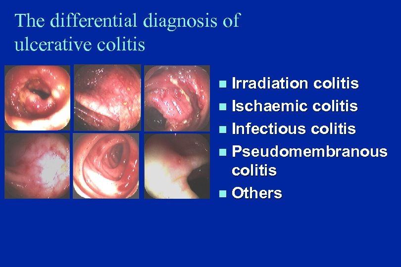 The differential diagnosis of ulcerative colitis Irradiation colitis n Ischaemic colitis n Infectious colitis