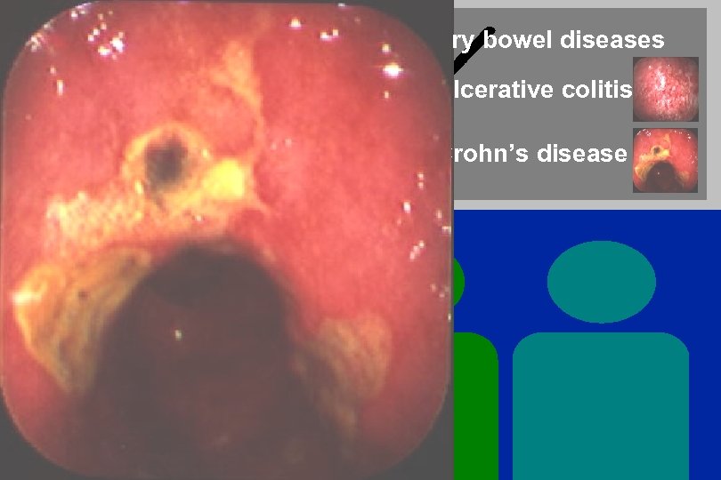 Inflammatory bowel diseases Ulcerative colitis Crohn’s disease 