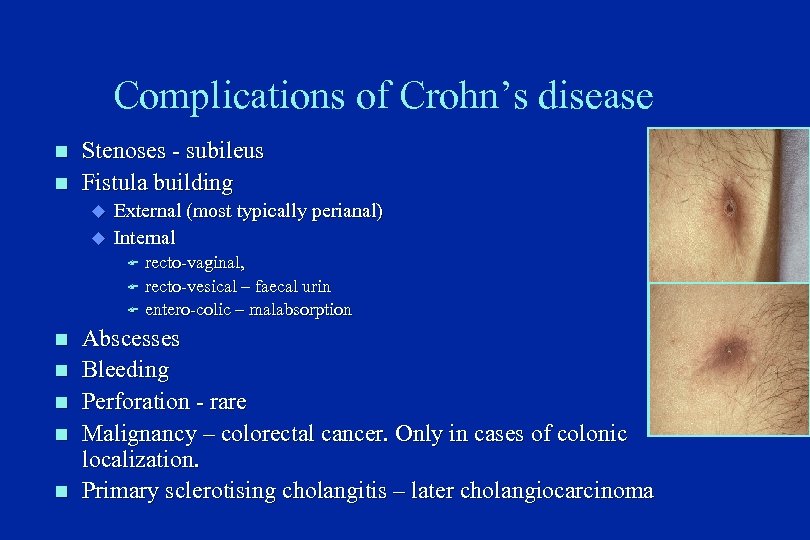 Complications of Crohn’s disease n n Stenoses - subileus Fistula building u u External