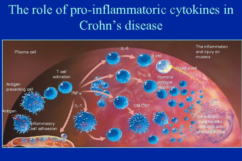 The role of pro-inflammatoric cytokines in Crohn’s disease IL-6 Plasma cell B sejt Plasma