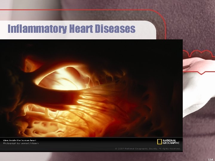 Inflammatory Heart Diseases 114 