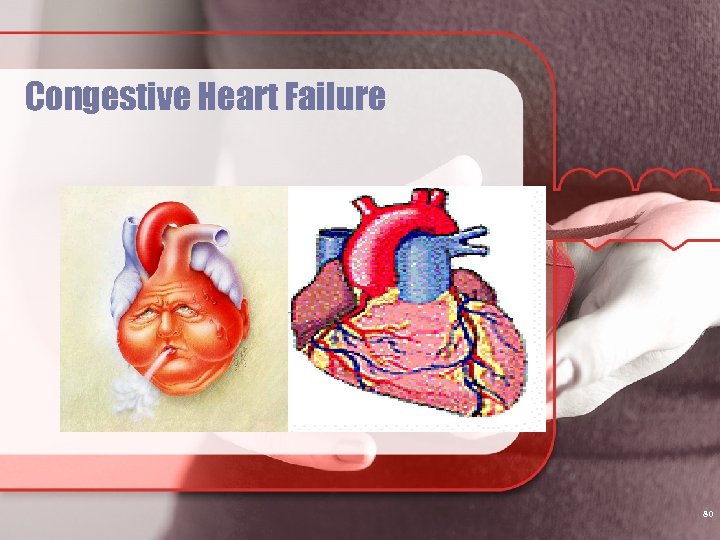Congestive Heart Failure 80 