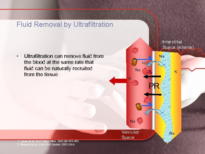 Fluid Removal by Ultrafiltration Interstitial Space (edema) • Ultrafiltration can remove fluid from the
