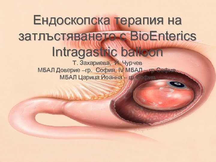 Ендоскопска терапия на затлъстяването с Bio. Enterics Intragastric balloon Т. Захариева, Й. Чурчев МБАЛ