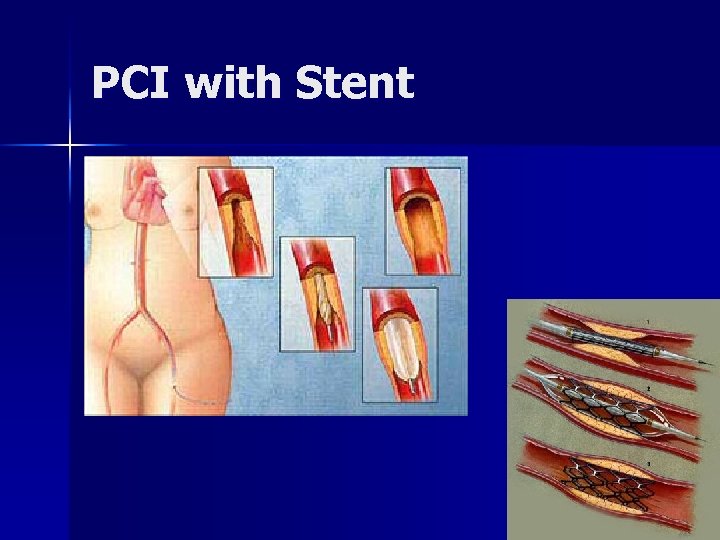 PCI with Stent 