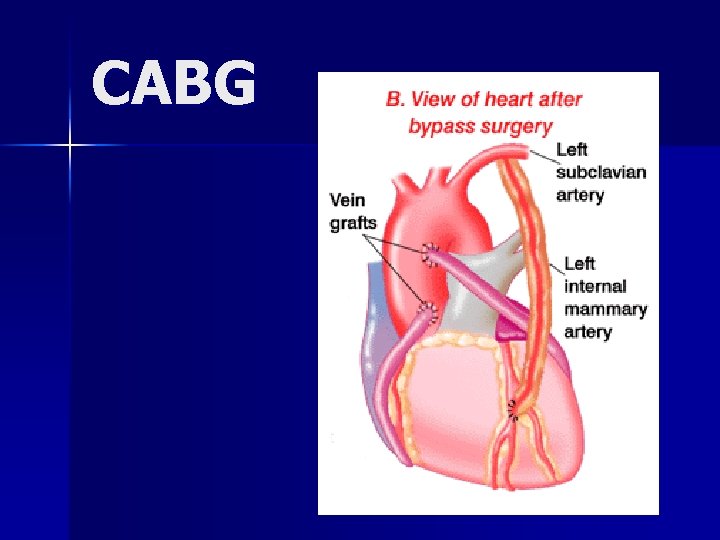 CABG 