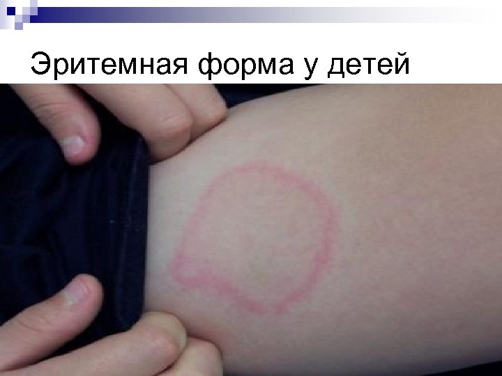 Эритемная форма у детей 