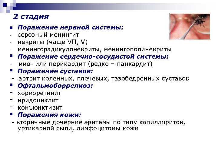 2 стадия Поражение нервной системы: - серозный менингит - невриты (чаще VII, V) -