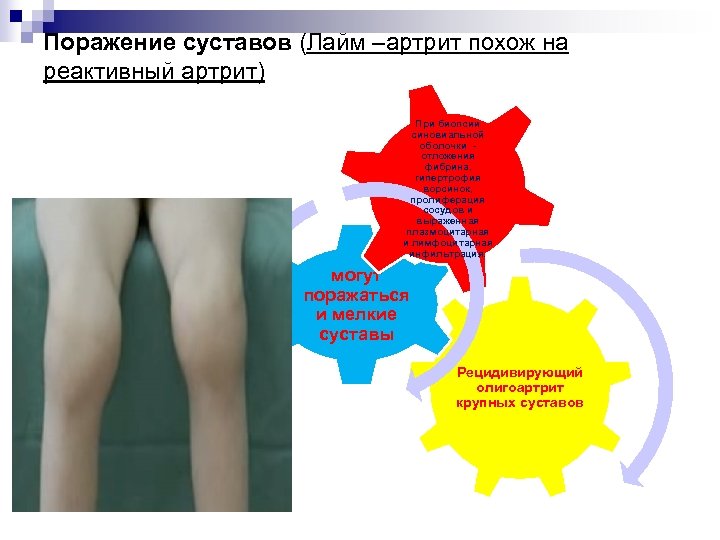 Поражение суставов (Лайм –артрит похож на реактивный артрит) При биопсии синовиальной оболочки - отложения