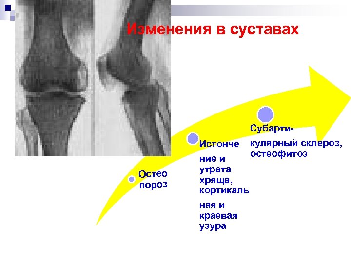 Остеофитоз. Краевые Узуры коленного сустава.