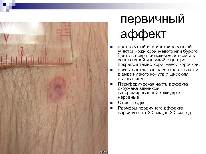 первичный аффект n n n плотноватый инфильтрированный участок кожи коричневого или бурого цвета с