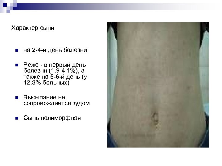 Характер сыпи n на 2 4 й день болезни n Реже в первый день