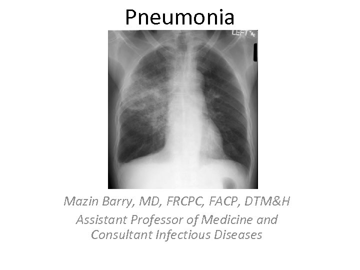 Pneumonia Mazin Barry, MD, FRCPC, FACP, DTM&H Assistant Professor of Medicine and Consultant Infectious