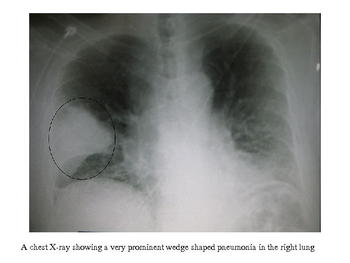 A chest X-ray showing a very prominent wedge shaped pneumonia in the right lung