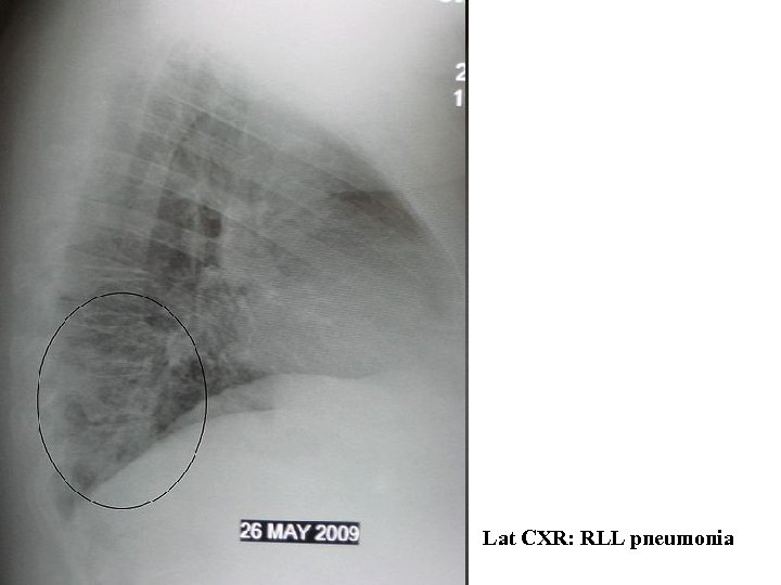 Lat CXR: RLL pneumonia 