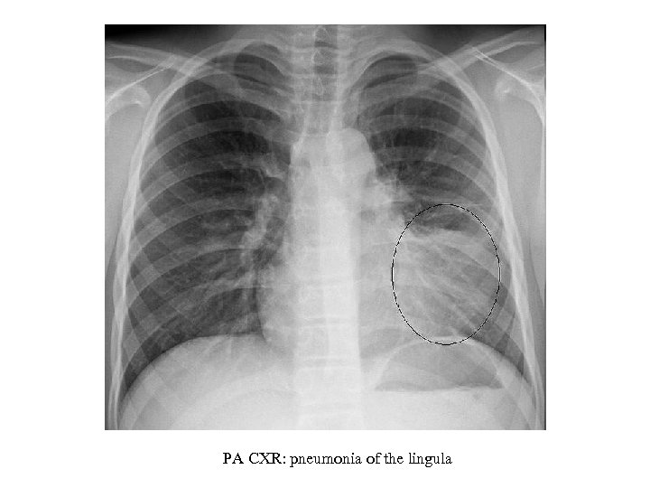 PA CXR: pneumonia of the lingula 