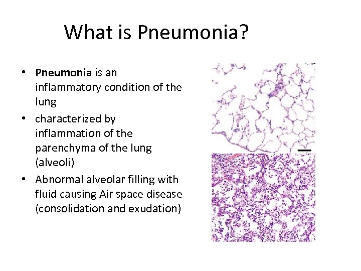 What is Pneumonia? • Pneumonia is an inflammatory condition of the lung • characterized