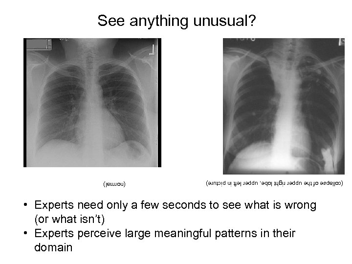 See anything unusual? (collapse of the upper right lobe, upper left in picture) (normal)