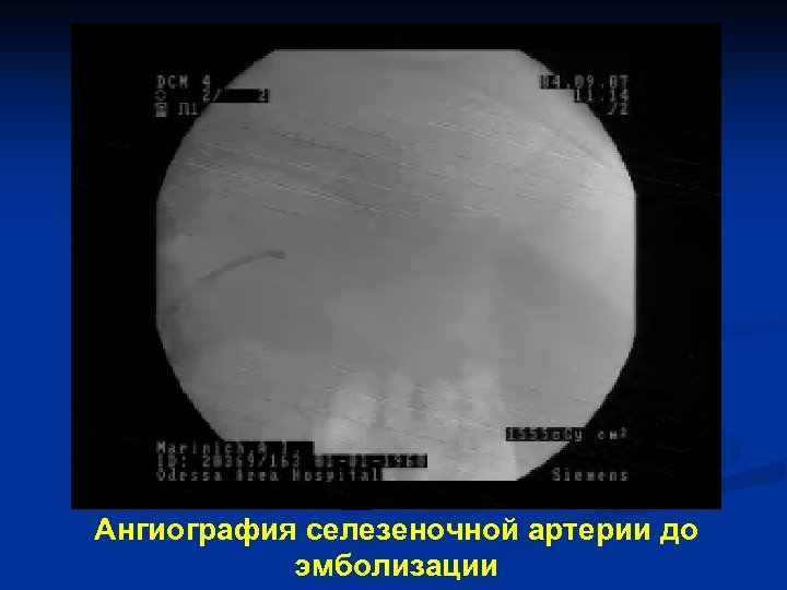 Ангиография селезеночной артерии до эмболизации 