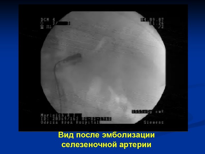 Вид после эмболизации селезеночной артерии 