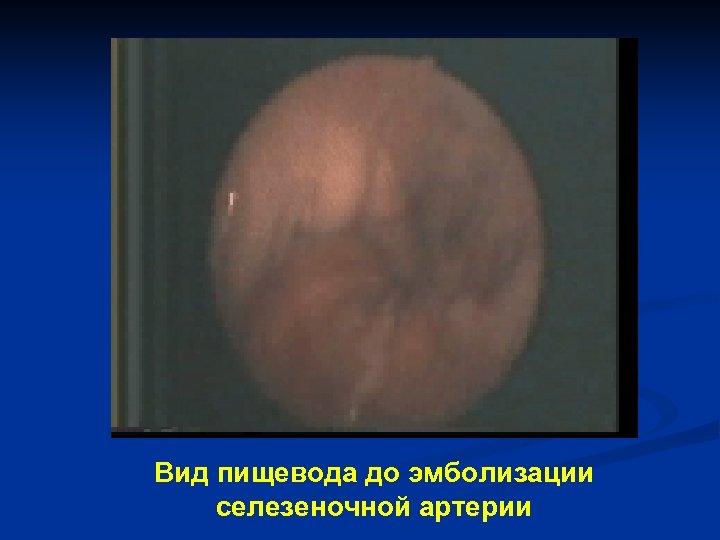 Вид пищевода до эмболизации селезеночной артерии 