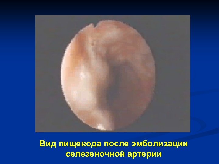 Вид пищевода после эмболизации селезеночной артерии 