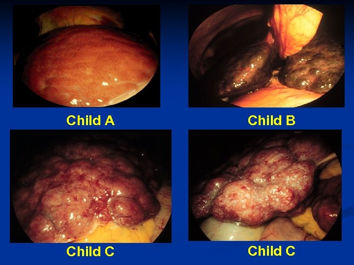 Child A Child B Child C 