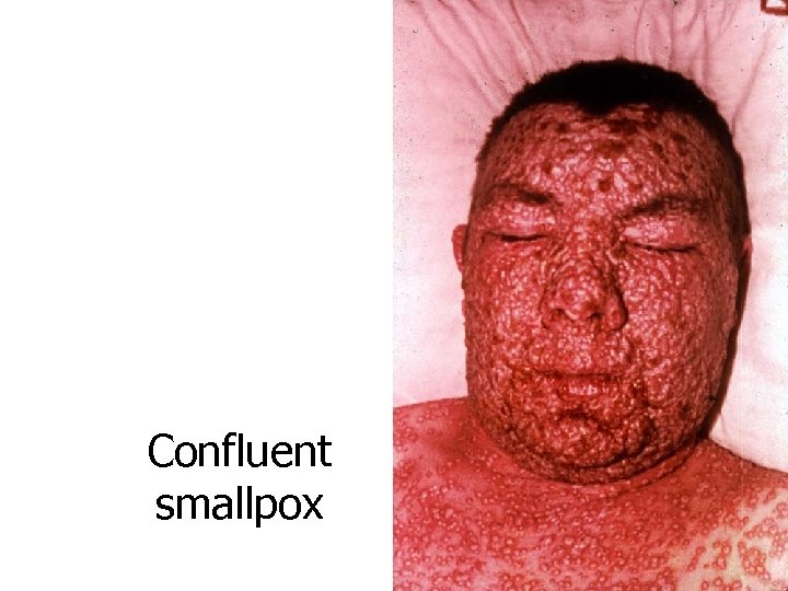 Confluent smallpox 