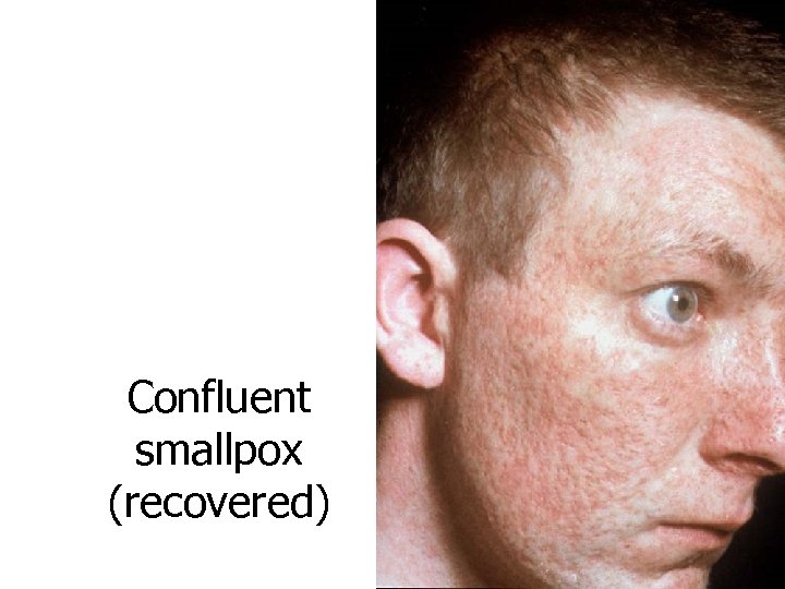 Confluent smallpox (recovered) 