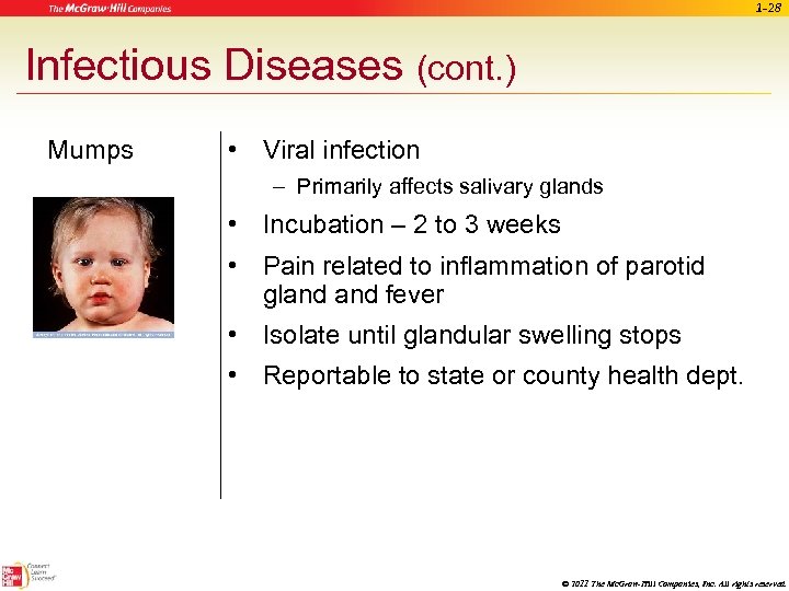 1 -28 Infectious Diseases (cont. ) Mumps • Viral infection – Primarily affects salivary